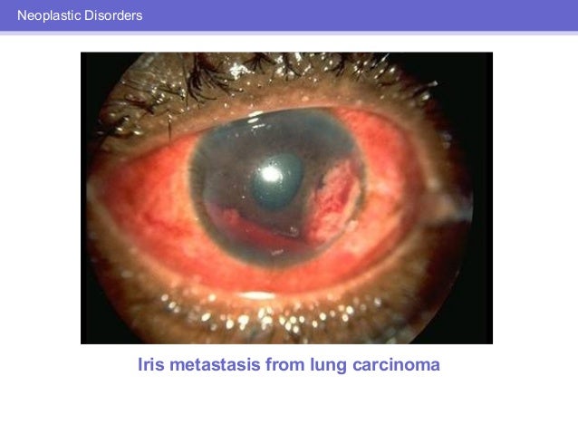 ocular inflamitory disease and breast cancer African teen hairstyles